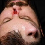 Iraqi surgeon grows nose on patient’s forehead in rare reconstruction surgery to correct facial damage in high-voltage electrical accident